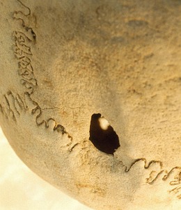 Ancient Greek Skull Surgery