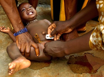 Genitalia mutilation