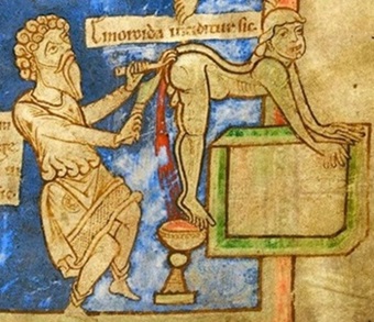 Hemorojaus gydymas Viduramžiais