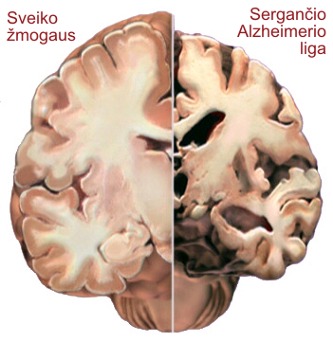 Brain difference: Alzheimer disease